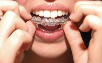 Как выпрямляют зубы брекетами